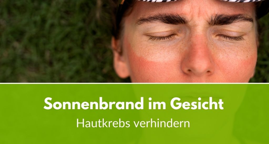 Gesicht Brennt Wie Bei Sonnenbrand kressesalbe.de