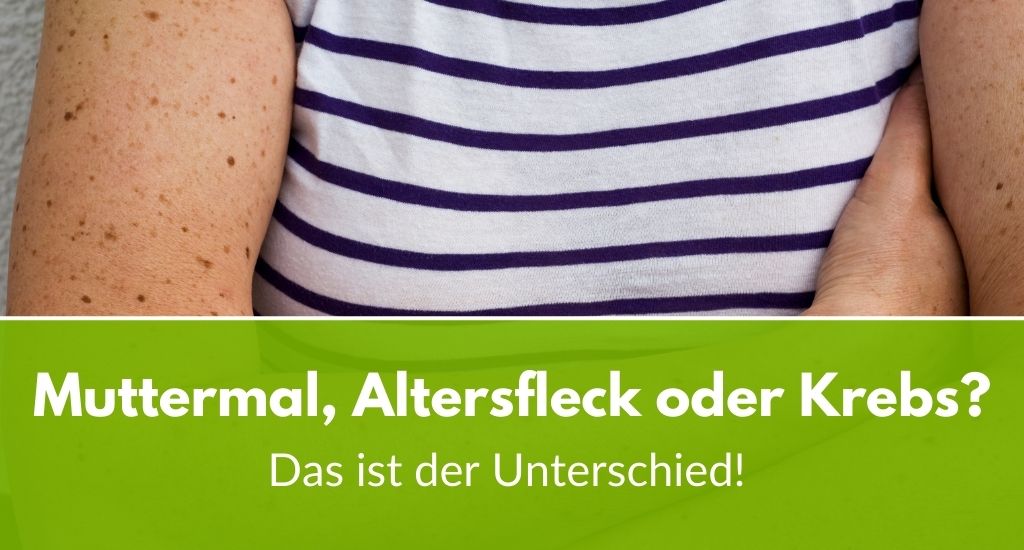 Muttermal, Altersfleck oder Krebs? Das ist der Unterschied!