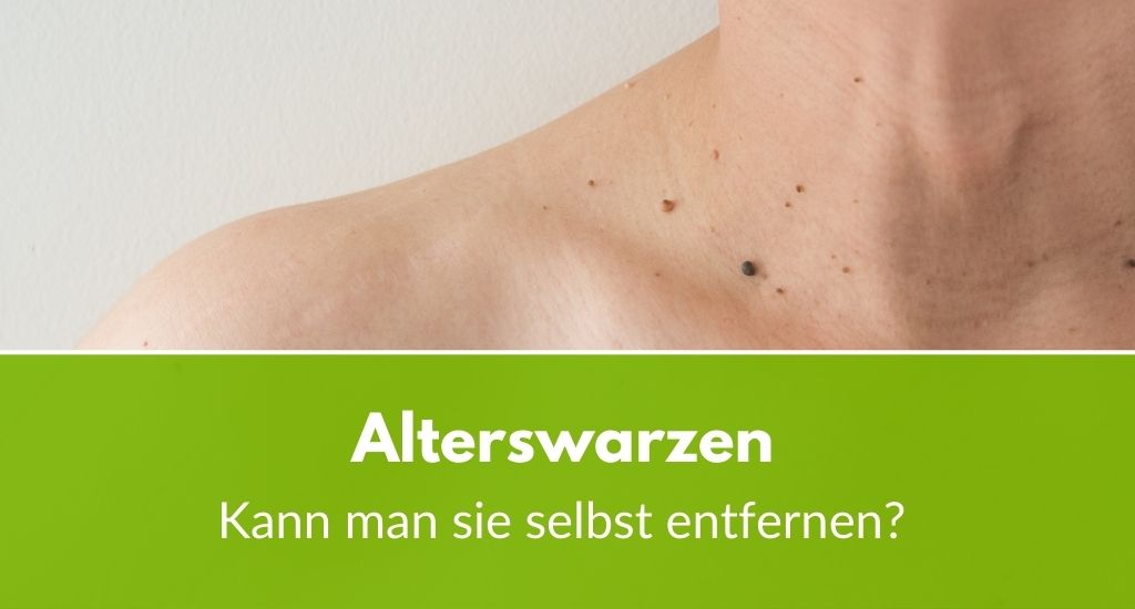 Alterswarzen selbst entfernen: Funktioniert das?