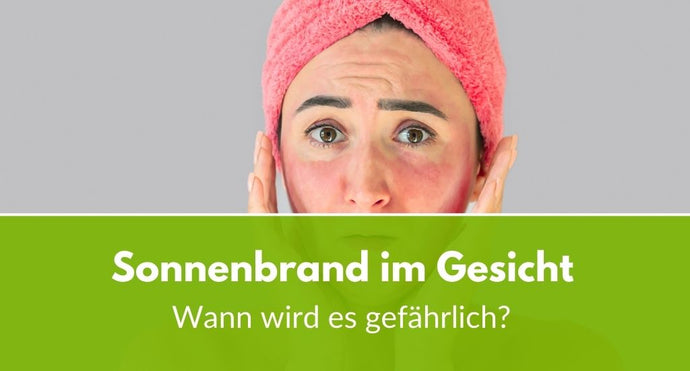 Sonnenbrand im Gesicht: Ab wann wird es gefährlich?