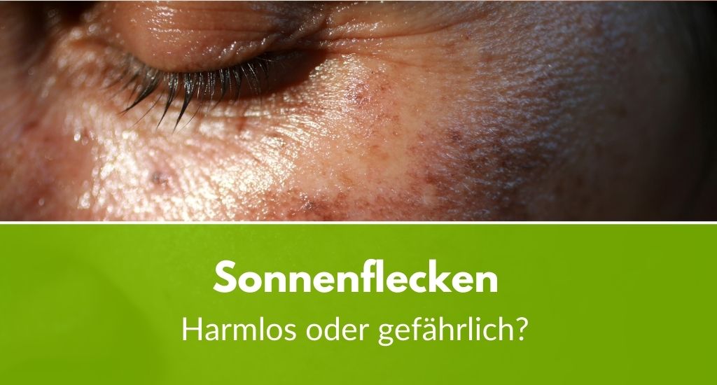 Sonnenflecken auf der Haut: Harmlos oder gefährlich?