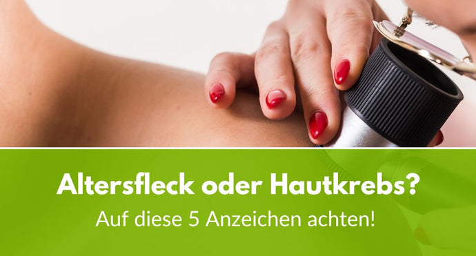 Altersfleck oder Hautkrebs? 5 typische Anzeichen