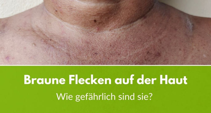 Braune Flecken auf der Haut: Wie gefährlich sind sie?