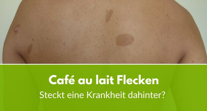 Café au lait Flecken: Steckt eine Krankheit dahinter?