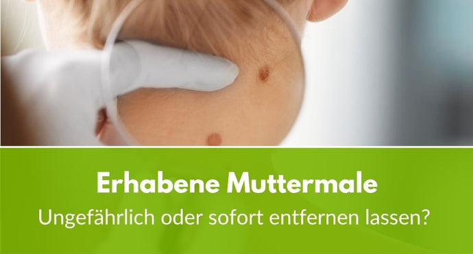 Erhabene Muttermale: Ungefährlich oder sofort entfernen lassen?
