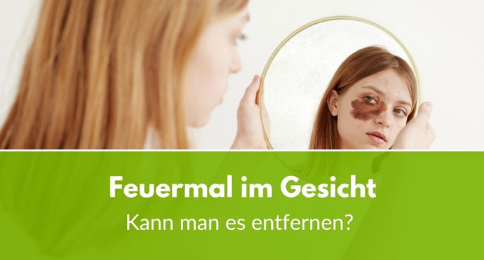 Feuermal im Gesicht: Kann man es entfernen?