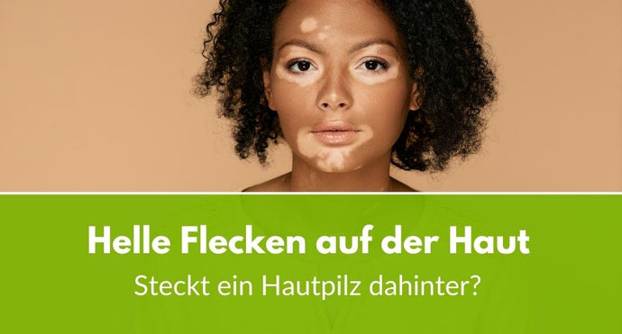 Helle Flecken auf der Haut: Steckt ein Hautpilz dahinter?