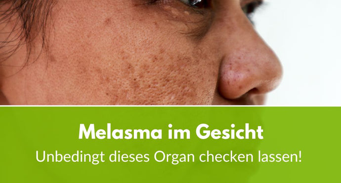 Melasma im Gesicht: Unbedingt dieses Organ checken lassen!