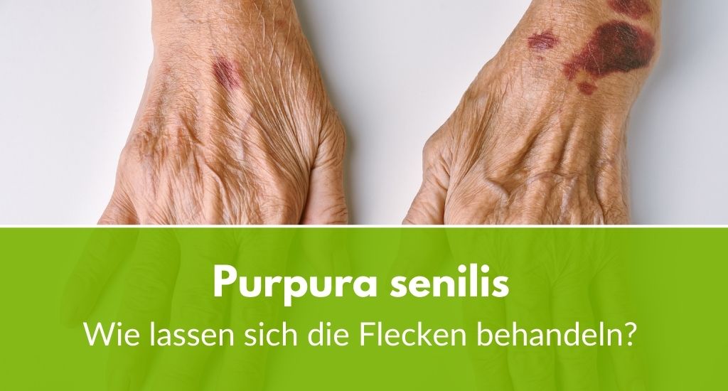 Purpura senilis Wie lassen sich die Flecken behandeln?
