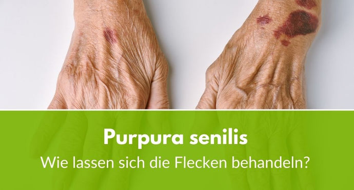 Purpura senilis: Wie lassen sich die Flecken behandeln?
