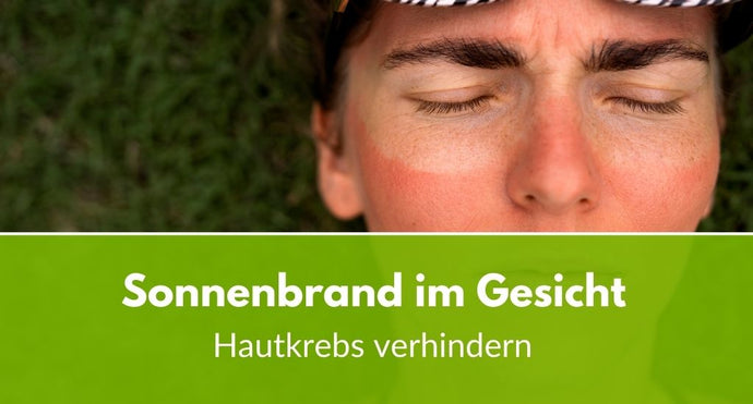 Sonnenbrand im Gesicht: So verhinderst du Hautkrebs